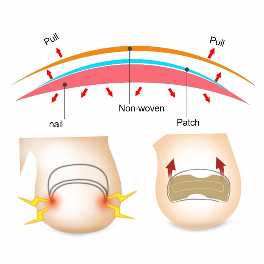 Glue Free Toenail Patch - Image 3