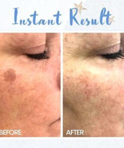 Removal Pen,Spot Removal,Spot,Removal,Pen