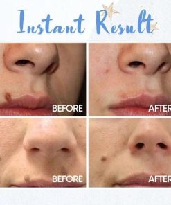 Removal Pen,Spot Removal,Spot,Removal,Pen