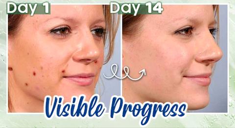 ActiveSkin Mole Removal Serum