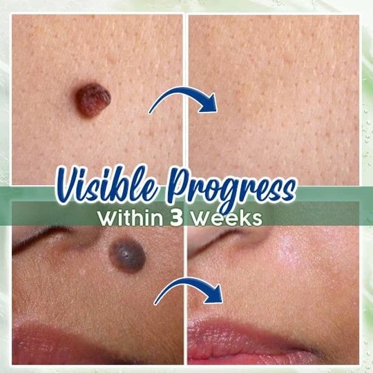 ActiveSkin Mole Removal Serum - Image 2