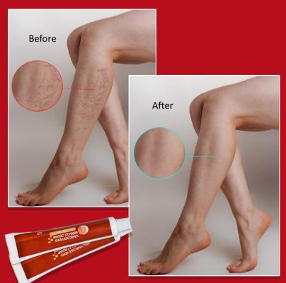 Varicose Veins Miracle Cream