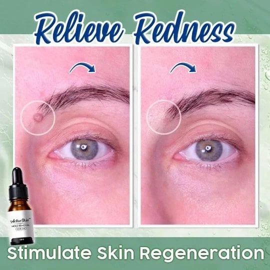 ActiveSkin Mole Removal Serum - Image 5
