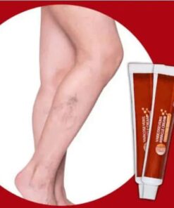 Varicose Veins Miracle Cream