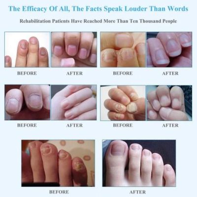 Dr PRO Anti-fungal Home Treatment Set