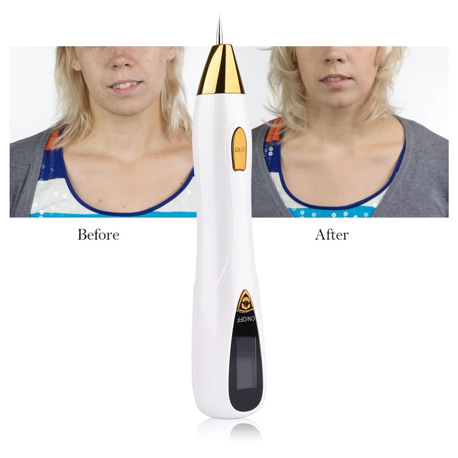Deluxe Skin Tag And Mole Remover Pen - Image 4