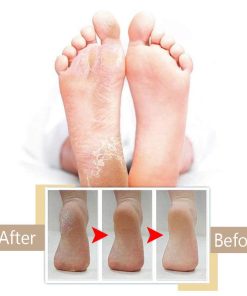 CallusRemedy Foot Tool