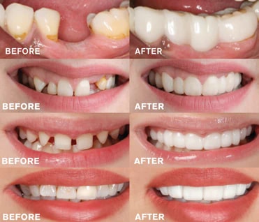 Magic Teeth Brace,magic teeth,magic teeth braces,magic smile teeth brace,best clip on veneers