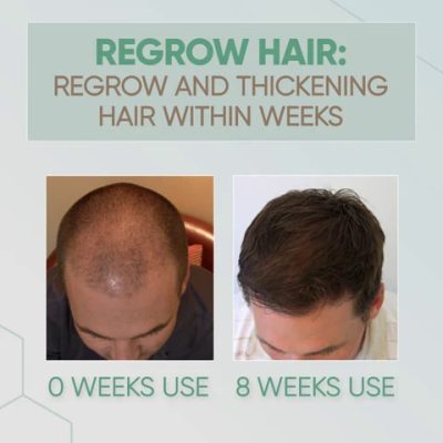 GingerGrowth Hair Regrow Spray,hair thinning,hair roots,hair growth,hair loss treatments