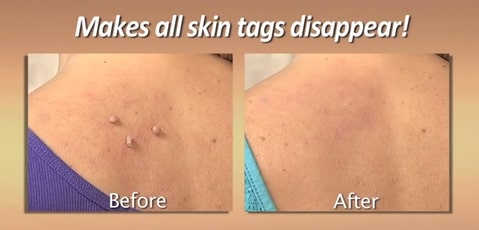 Copper Tag Out Skin Tag Remover,copper tag out,skin tag removal cvs,copper skin tag remover,homeopathic skin tag remover