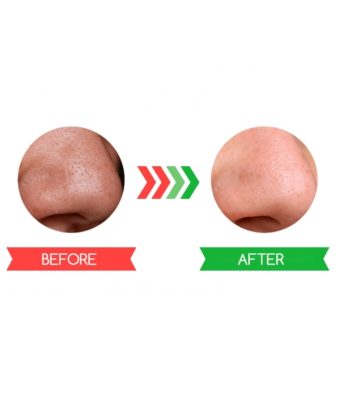 blackhead removal,Black Mask,awesome mask,Black Mask set,Black Mask – Peel off Mask