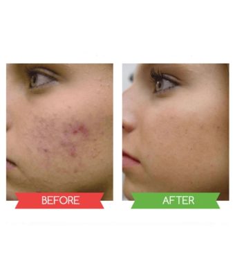 blackhead removal,Black Mask,awesome mask,Black Mask set,Black Mask – Peel off Mask