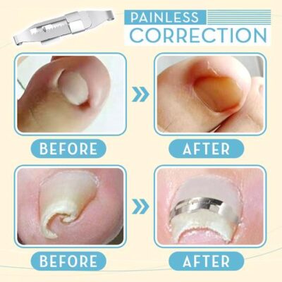 Toenails Correction Stainless Steel Clip Buckle,toenails,toenail growth,nails grow,abnormal nails