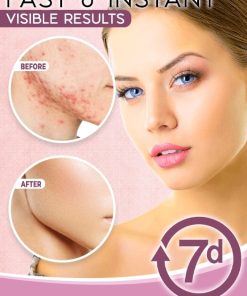 Acne Clearing Light Therapy,Acne Clearing,Light Therapy,Acne Clearing Light