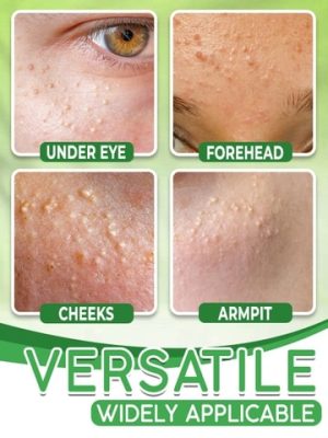 Milia Removal Cream,Eye Milia Removal Cream,Eye Milia Removal,Eye Milia,Cream