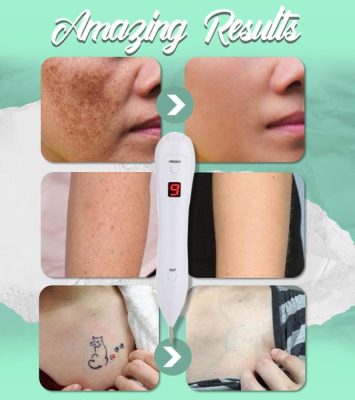 Spot Removal,Plasma Laser Pen,Laser Pen,Spot Removal Pen