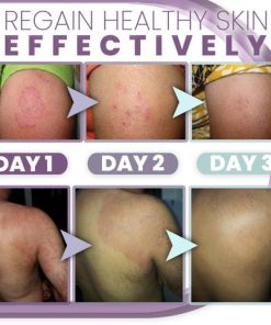 3 Days Anti Fungal Rash Cream,Anti Fungal Rash Cream,Rash Cream,3 Days Anti Fungal