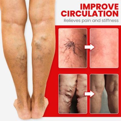 Red Agate,Varicose,Vein Cure,Anklet,Red Agate Varicose Vein Cure Anklet