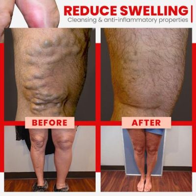 Red Agate,Varicose,Vein Cure,Anklet,Red Agate Varicose Vein Cure Anklet