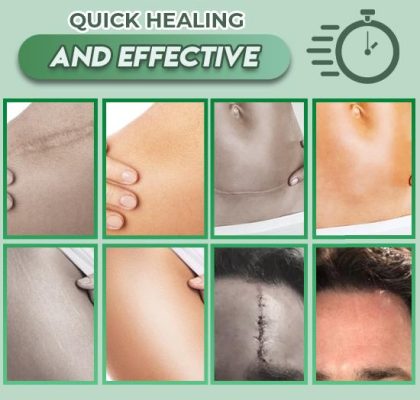 Reusable Surgery Scar Removal Silicone Gel,Surgery Scar Removal Silicone Gel,Scar Removal Silicone Gel,Scar Removal,Silicone Gel
