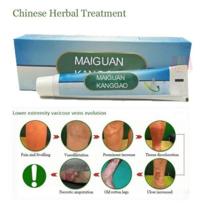 Varicose Veins Treatment Cream,Veins Treatment Cream,Treatment Cream,Varicose Veins Treatment,Varicose Veins
