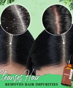 Anti-Dandruff Treatment Essence,Treatment Essence,Anti-Dandruff