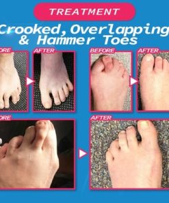 Hallux Valgus Corrector,Hallux Valgus,Valgus Corrector