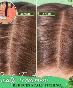 Anti-Dandruff Treatment Essence,Treatment Essence,Anti-Dandruff