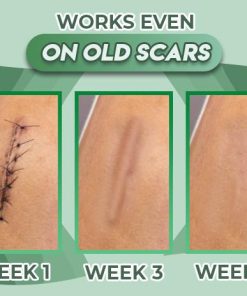 Reusable Surgery Scar Removal Silicone Gel,Surgery Scar Removal Silicone Gel,Scar Removal Silicone Gel,Scar Removal,Silicone Gel