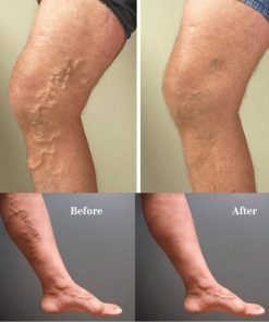 Varicose Veins Treatment Cream,Veins Treatment Cream,Treatment Cream,Varicose Veins Treatment,Varicose Veins