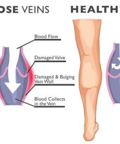 Varicose Veins Treatment Cream,Veins Treatment Cream,Treatment Cream,Varicose Veins Treatment,Varicose Veins