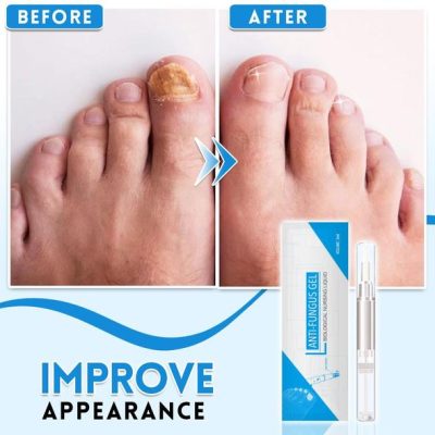 Anti-Fungus Repairing Pen,Fungus Repairing Pen,Repairing Pen,Fungus Repairing,Anti-Fungus