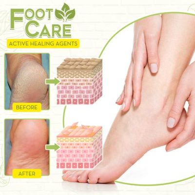 Fungal Reverse Herbal Treatment Foot Soak,Reverse Herbal Treatment Foot Soak,Herbal Treatment Foot Soak,Treatment Foot Soak,Foot Soak