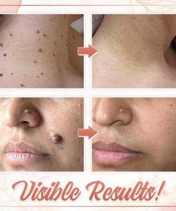 Herbal Wart Skin Removal Ointment,Skin Removal Ointment,Skin Removal,Herbal Wart,Removal Ointment