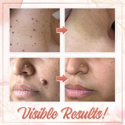 Herbal Wart Skin Removal Ointment,Skin Removal Ointment,Skin Removal,Herbal Wart,Removal Ointment