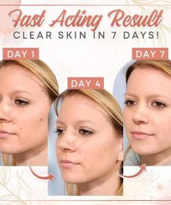 Herbal Wart Skin Removal Ointment,Skin Removal Ointment,Skin Removal,Herbal Wart,Removal Ointment