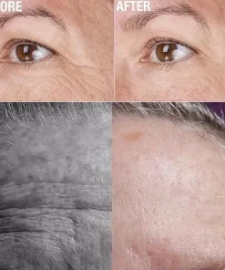 Lifting Decree Patch,Decree Patch,Hyaluronic Acid,Microcrystalline Lifting