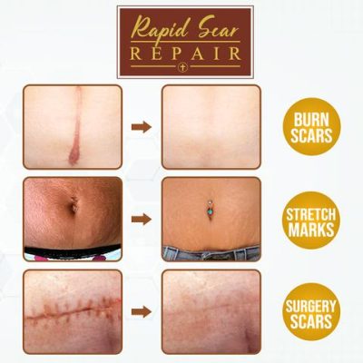 Body Mark Repair Treatment Gel,Repair Treatment Gel,Treatment Gel,Body Mark