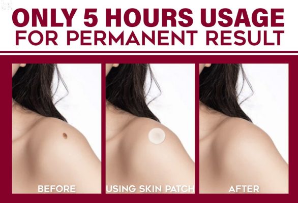 Spots Removal Treatment Patches Set,Spots Removal Treatment Patches,Spots Removal,Treatment Patches Set,Treatment Patches