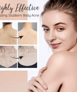 Acne Treatment Body Spray,Acne Treatment,Body Spray,Treatment Body Spray,Acne Treatment Body