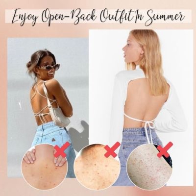 Acne Treatment Body Spray,Acne Treatment,Body Spray,Treatment Body Spray,Acne Treatment Body