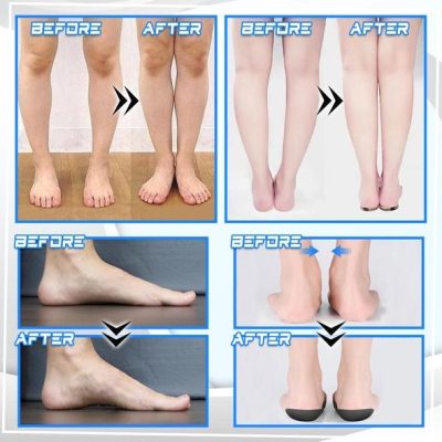 Flat Foot Correcting Insoles,Foot Correcting Insoles,Correcting Insoles,Flat Foot Correcting,Flat Foot