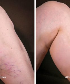Varicose Veins Treatment Cream,Veins Treatment Cream,Treatment Cream,Varicose Veins Treatment,Varicose Veins