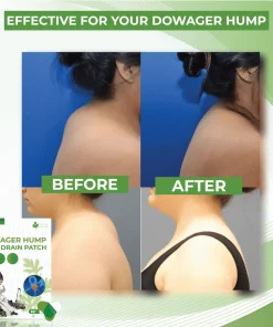 DowagerHump NeckDrain Patch