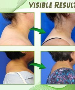 Dowager's Hump Neck Drain Patch,Hump Neck,Drain Patch,Neck Drain,Dowager's Hump