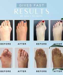 Elastic Two Toes Hallux Valgus Corrector,Hallux Valgus Corrector,Elastic Two Toes,Valgus Corrector