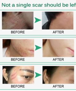 Scar Removal Cream,Scar Removal,Intensive Scar Removal Cream,Intensive Scar Removal