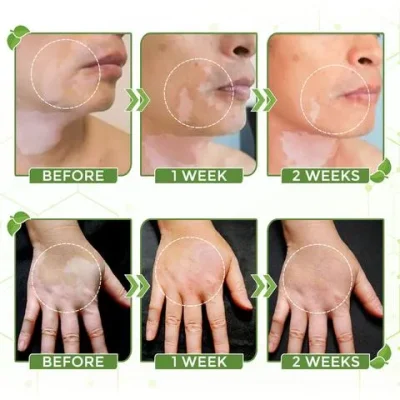 White Tag Treatment Moisturizing Cream,White Tag Treatment,Moisturizing Cream