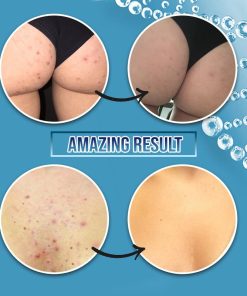 Miracle BlemishFree SkinCream