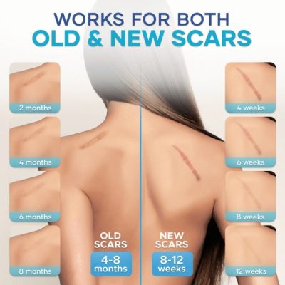 Vanish Scar Cream,Scar Cream